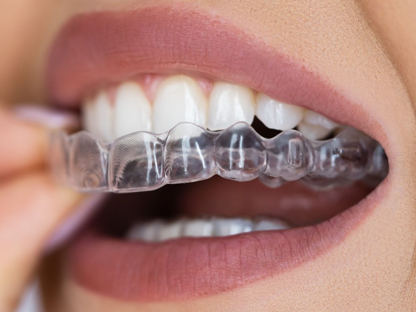 Person setzt eine transparente Knirschschiene ein